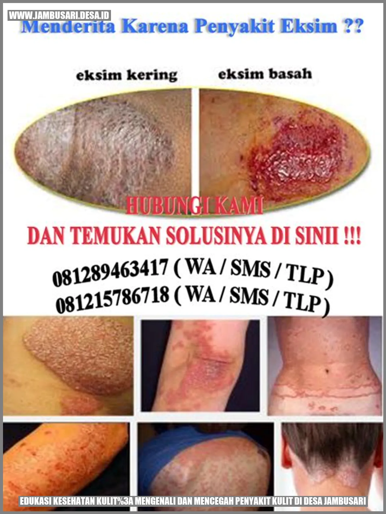 Edukasi Kesehatan Kulit: Mengenali dan Mencegah Penyakit Kulit di Desa Jambusari